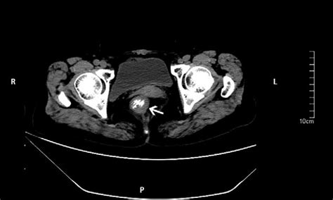 Abdominal Ct Findings A Polypoid Lesion With Homogeneous Low