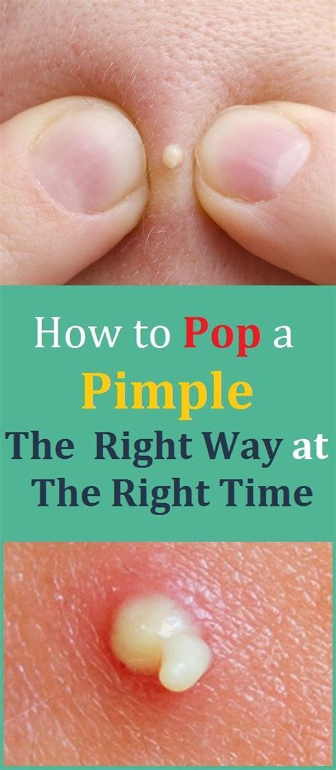 How To Pop A Pimple The Right Way At The Right Time Pimples Pop