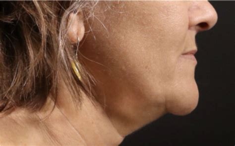 Best Facial Exercises To Get Rid Of Sagging Jowls