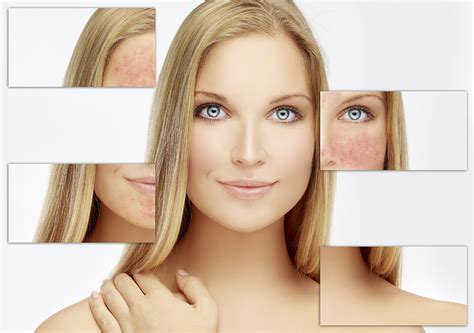 Dermis Rosacea Dermis Advanced Skin Care Ottawa