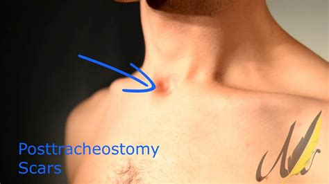 Trakeostomi Izi Onarımı Tracheostomy Scar Correction Youtube