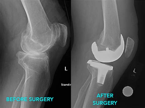 Arthroplasty Joint Replacement Surgery Hip Knee Shoulder Thumb