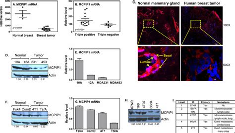 Mcpip1 Expression Is Impaired In Breast Tumors And Breast Tumor Cell