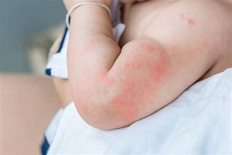Hives On Baby Causes Treatment Remedies And Prevention
