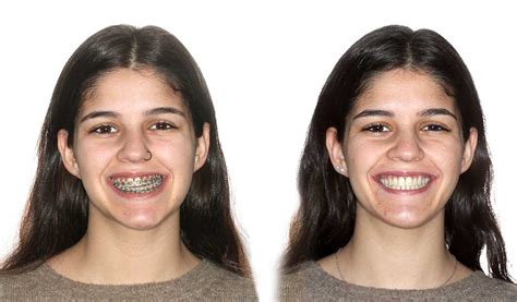 ¿cuáles Son Las Etapas De Un Tratamiento De Ortodoncia Y Cirugía Globalorthodontics