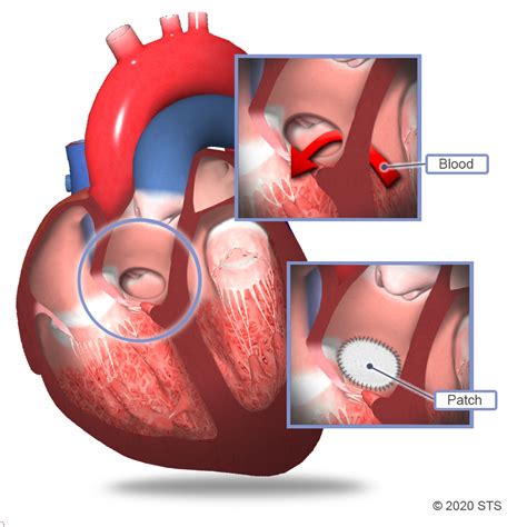 Ventricular Septal Defect Surgery The Patient Guide To Heart Lung And Esophageal Surgery