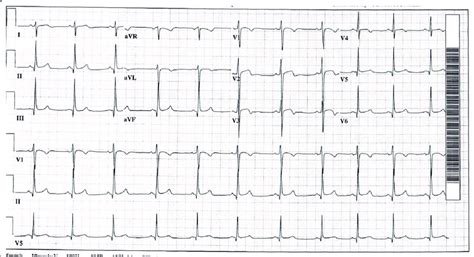 Ecg Showing Normal Sinus Rhythm Restored To 65 Beats Per Minute After A