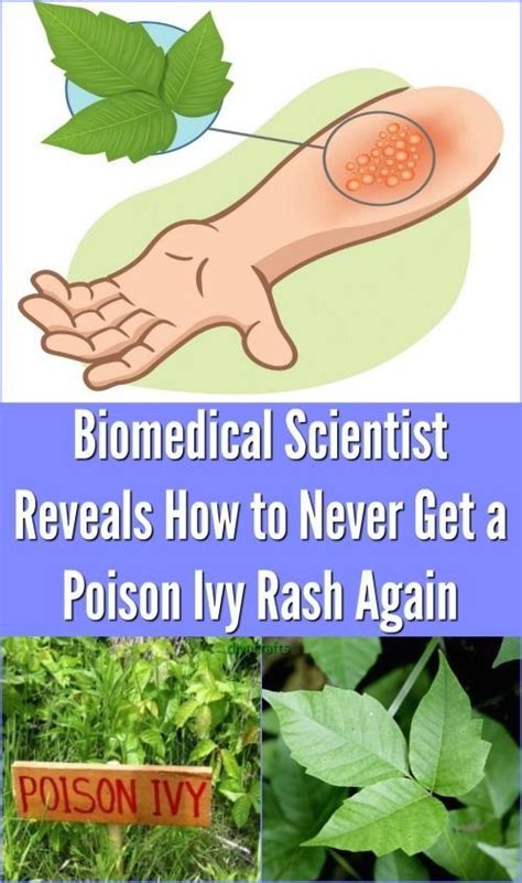 Biomedical Scientist Reveals How To Never Get A Poison Ivy Rash Again