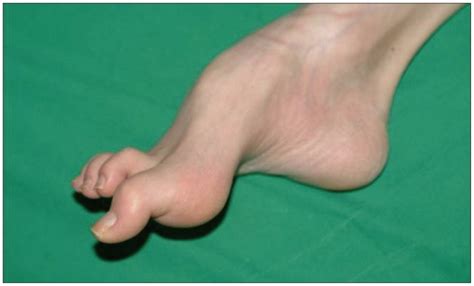 The Patients Right Foot Shows Deformities Of Pes Cavus And Hammertoes