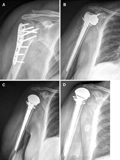 Operative Management Of Proximal Humerus Fractures A This Is A My Xxx