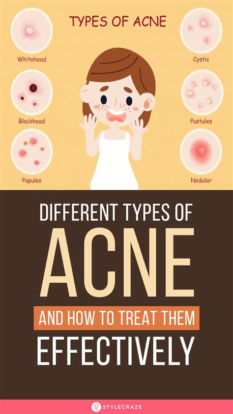 Different Types Of Acne And How To Treat Them Effectively Different