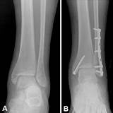 Photos of Loose Ligaments In Ankle Treatment