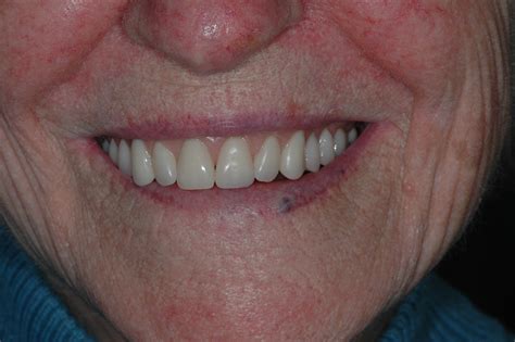 What Is A Permanent Partial Denture Partial Dentures Advanced