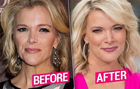 Megyn Kelly Facelift What Happened To Her Face Before And After Pics