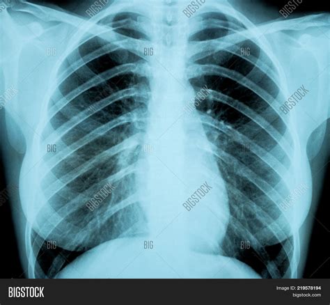 Woman Body X Ray X Rays Uses Procedure Results 3d Render