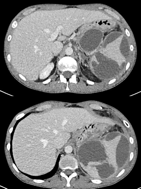 Pancreatic Pseudocyst Associated With Intrasplenic Extension And