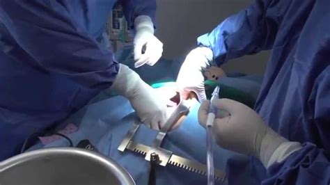 Cvicu Emergency Sternotomy Training Video Youtube