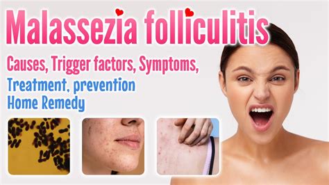 Malassezia Folliculitis Causes Symptoms Diagnosis Treatment
