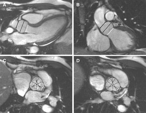 Aortic Root Measurement By Cardiovascular Magnetic Resonance