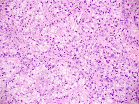 Pathology Outlines Clear Cell Carcinoma