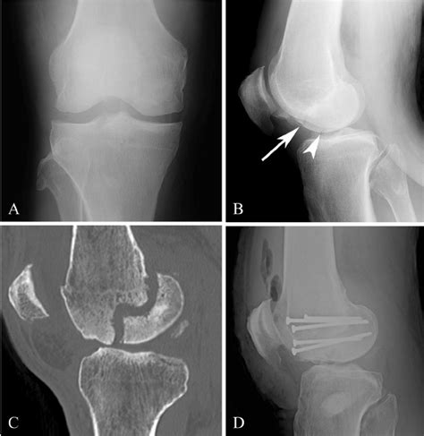 A 52 Year Old Male With Hoffa Fracture Of The Medial Femoral Condyle