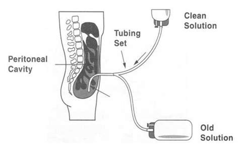 Peritoneal Dialysis Handouts