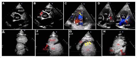 The Preoperative Transthoracic Echocardiography Tte And Contrast