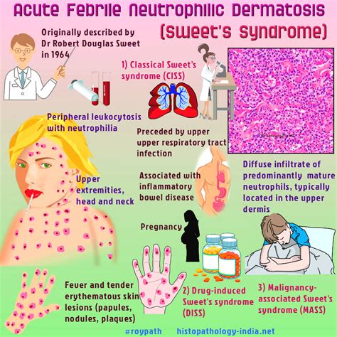 Pathology Of Acute Febrile Neutrophilic Dermatosis Sweets Syndrome