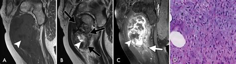 Soft Tissue Sarcomas Assessment Of Mri Features Correlating With