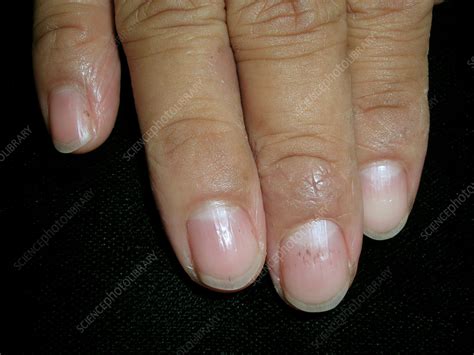 Pitted Nails Due To Severe Atopic Dermatitis Stock Image C0561057