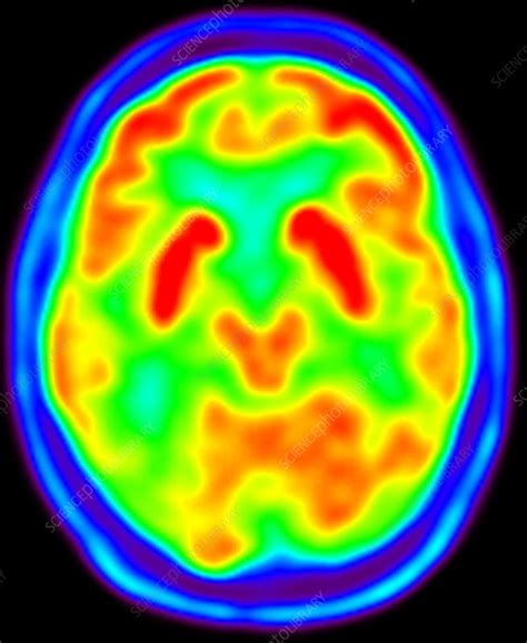 Normal Brain Pet Scan Stock Image C0393563 Science Photo Library