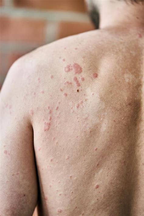 Skin Imperfection Skin Allergy Urticaria Disease Red Spots On The