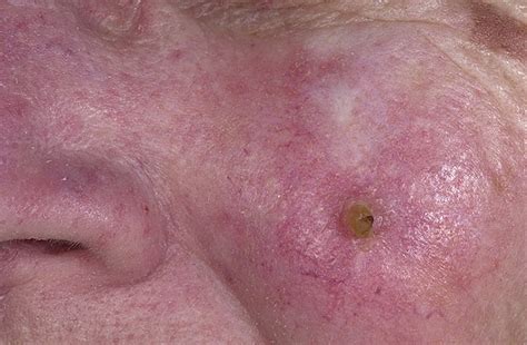 Skin Cancer On Face Pictures 33 Photos And Images