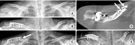 A Neer Type Iib Distal Clavicle Fracture B Open Reduction And