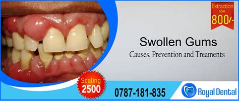 Royal Dental Clinic Articleuswollen Gums Causes Prevention And