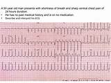 Electrical Alternans Pictures