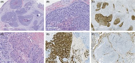 Histological Findings From Combined Large Cell Neuroendocrine And