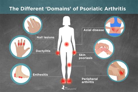 Different Types Of Psoriatic Arthritis Symptoms
