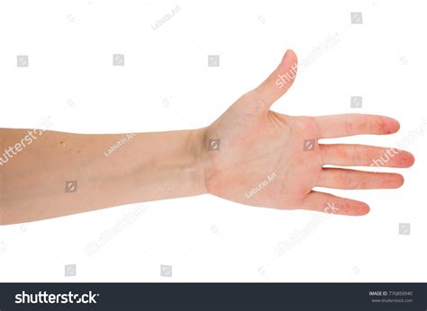 Womans Hand Wounds Eczema Dermatitis Stock Photo 776859940 Shutterstock