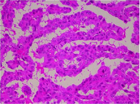 Oncocytic Papillary Thyroid Carcinoma Showing Thyrocytes With