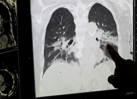 4dmedical Lung Imagery Sheds More Light On Long Covid Effects Reuters