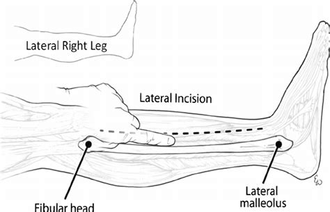 The Fibular Head And Lateral Malleolus Are Reference Points To Mark The