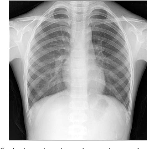 Figure 1 From Pediatric Mycoplasma Pneumoniae Infection Presenting With