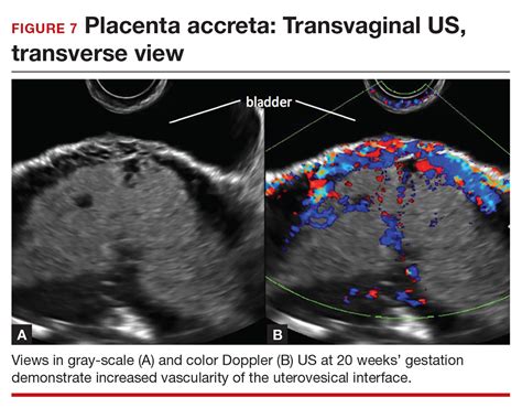 Placenta Accreta Grades Of Abnormal Attachment Illust