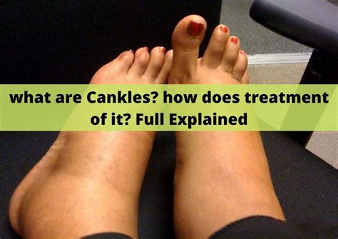 What Are Cankles How Does Treatment Of It Full Explained