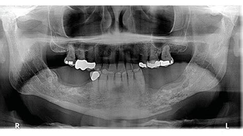 Osteoradionecrosis And Oral Health Care Decisions In Dentistry