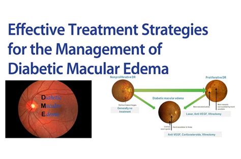 Diabetic Macular Edema And Treatment Strategies Obn