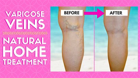 Home Remedies For Varicose Veins Treatment Natural Varicose Veins