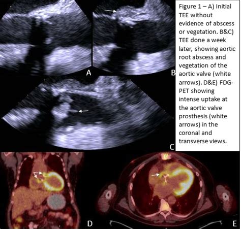 Detection Of Prosthetic Aortic Valve Endocarditis With Root Abscess