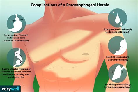 Paraesophageal Hiatal Hernia Complications